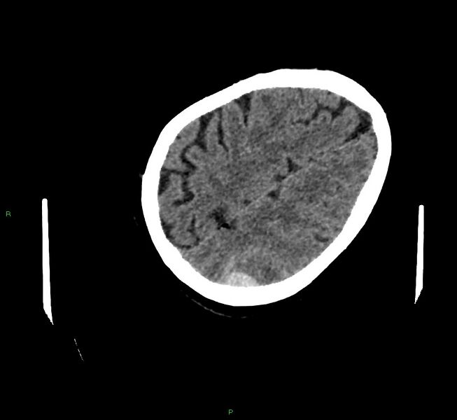 File:Cerebral amyloid angiopathy-associated lobar intracerebral hemorrhage (Radiopaedia 58757-65979 Axial non-contrast 109).jpg
