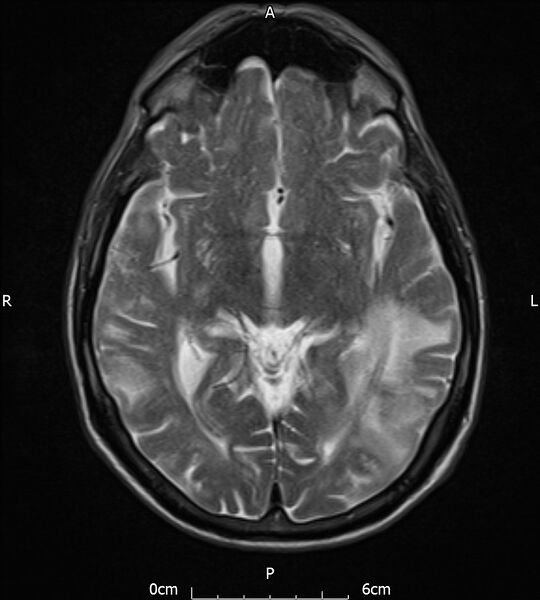 File:Cerebral amyloid angiopathy related inflammation (Radiopaedia 72772-83415 Axial T2 11).jpg