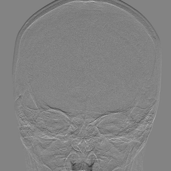 File:Cerebral aneurysm with rupture (Radiopaedia 29933-30458 LT CCA IC 6).jpg
