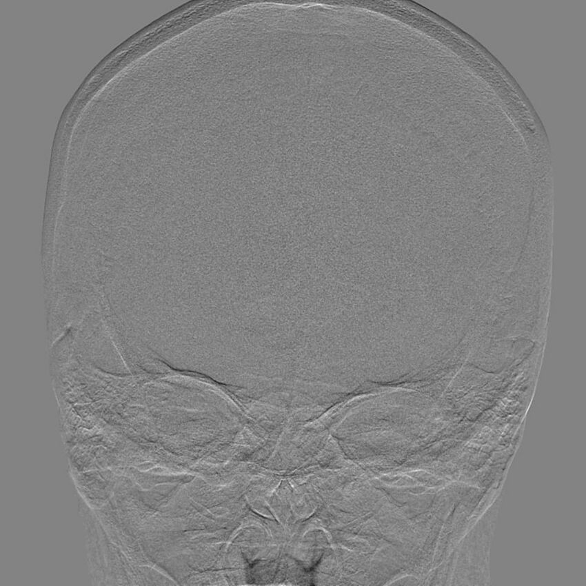 Cerebral aneurysm with rupture (Radiopaedia 29933-30458 LT CCA IC 6).jpg