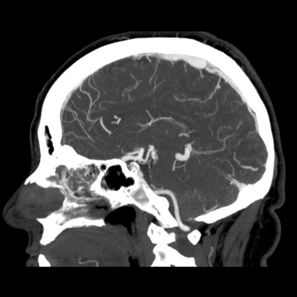 File:Cerebral arteriovenous malformation (Radiopaedia 43729-47189 D 27).jpg