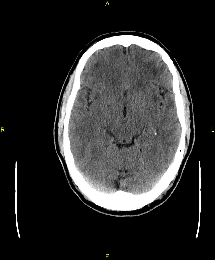Cerebral autosomal dominant arteriopathy with subcortical infarcts and leukoencephalopathy (CADASIL) (Radiopaedia 86108-102051 Axial non-contrast 43).jpg