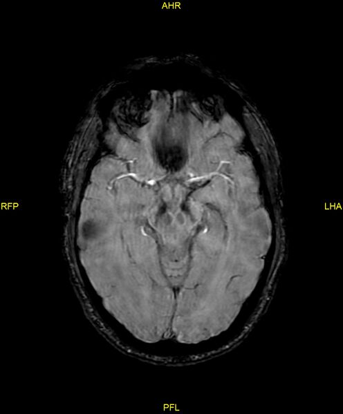 File:Cerebral autosomal dominant arteriopathy with subcortical infarcts and leukoencephalopathy (CADASIL) (Radiopaedia 86108-102054 Axial SWI 47).jpg