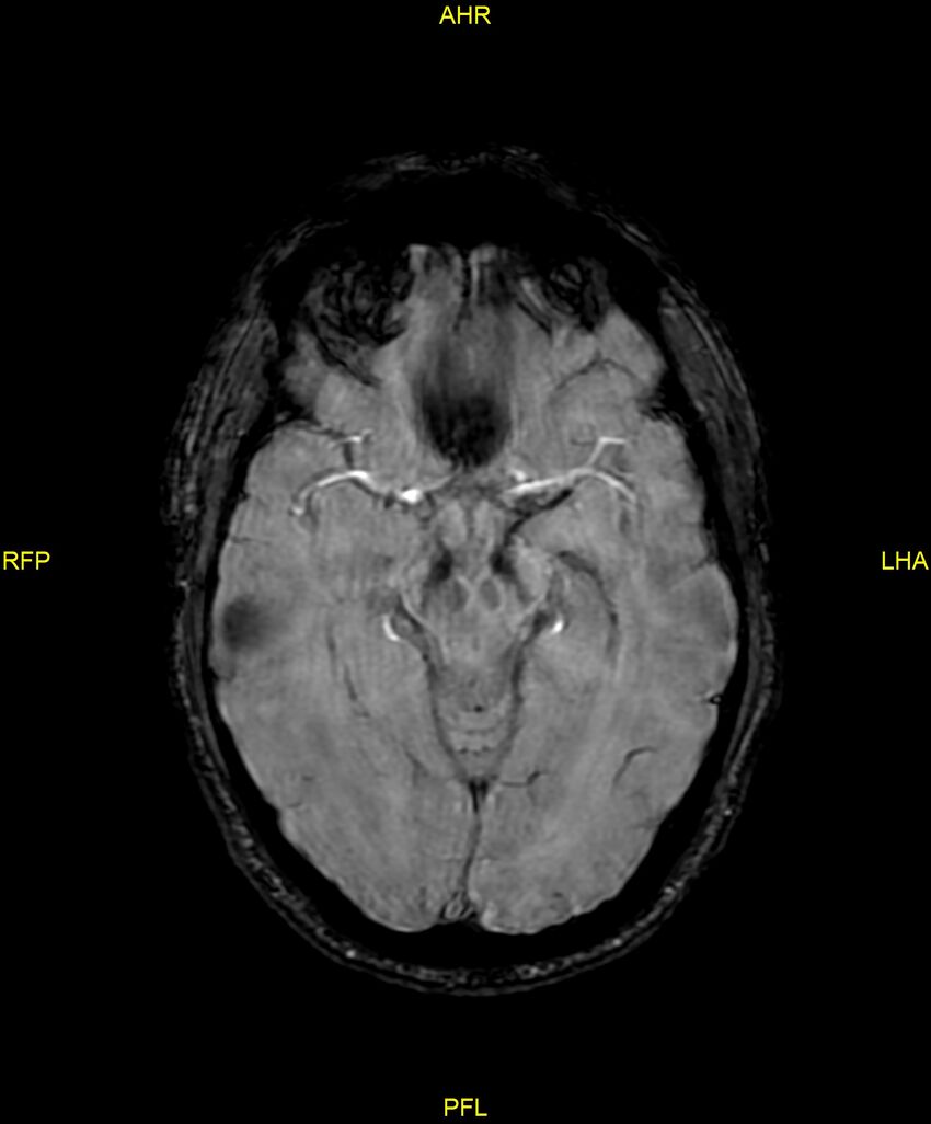 Cerebral autosomal dominant arteriopathy with subcortical infarcts and leukoencephalopathy (CADASIL) (Radiopaedia 86108-102054 Axial SWI 47).jpg