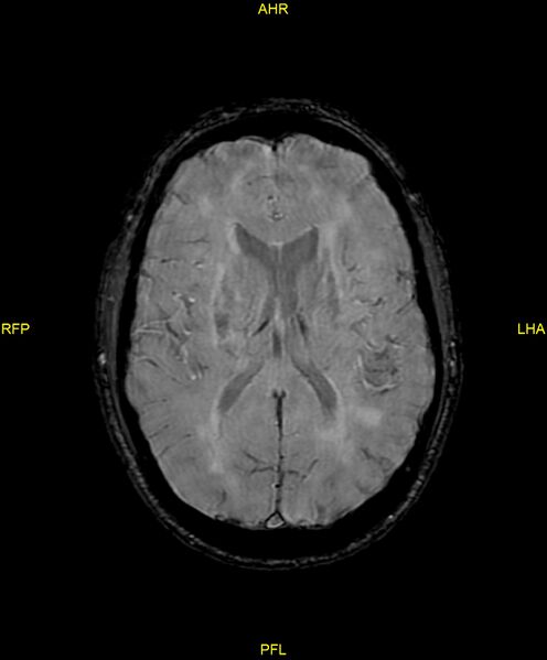File:Cerebral autosomal dominant arteriopathy with subcortical infarcts and leukoencephalopathy (CADASIL) (Radiopaedia 86108-102054 Axial SWI 63).jpg