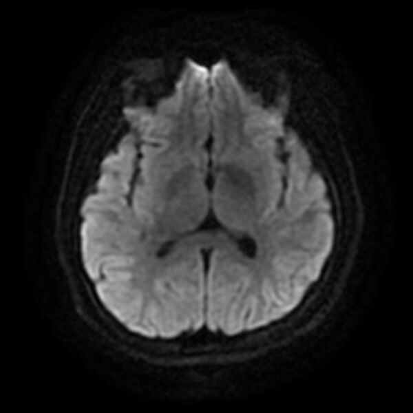 File:Cerebral cavernous malformation (Radiopaedia 44301-47942 Axial DWI 11).jpg