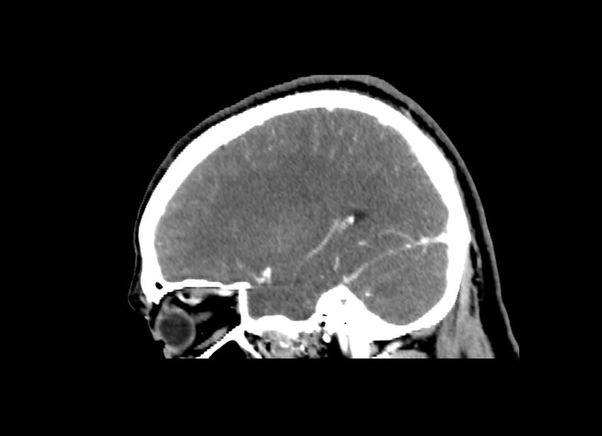 Cerebral edema (Radiopaedia 82519-96661 D 18).jpg