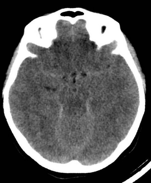 File:Cerebral edema due to severe hyponatremia (Radiopaedia 89826-106937 Axial non-contrast 35).jpg