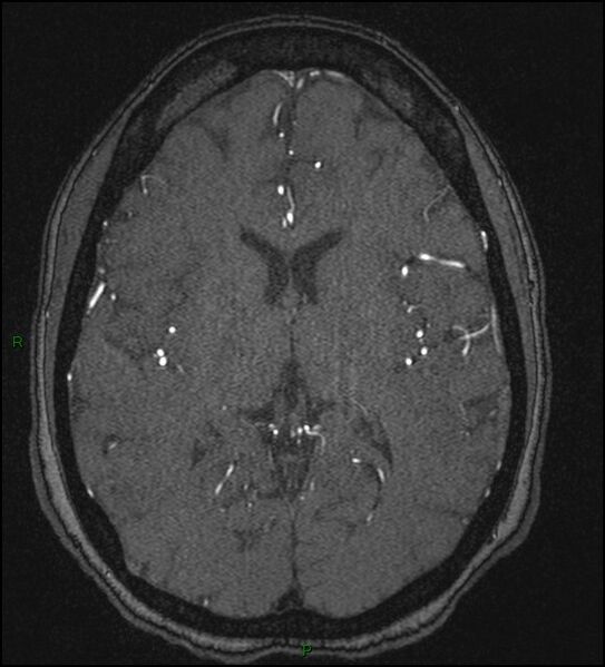 File:Cerebral fat embolism (Radiopaedia 35022-36525 Axial TOF 115).jpg