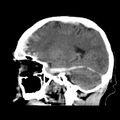 Cerebral hemorrhagic contusions (Radiopaedia 23145-23188 C 16).jpg