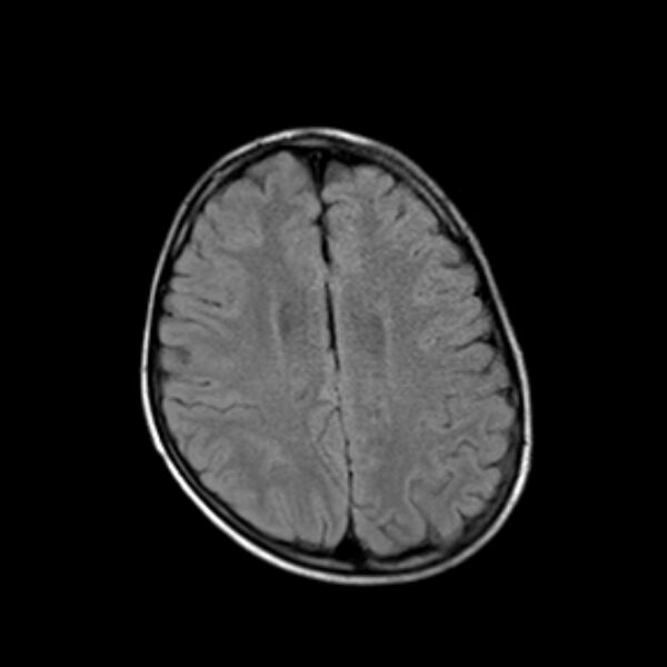 File:Cerebral tuberculoma (Radiopaedia 41152-43932 Axial FLAIR 16).jpg