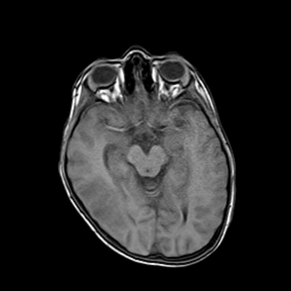 File:Cerebral tuberculoma (Radiopaedia 41152-43932 Axial T1 9).jpg