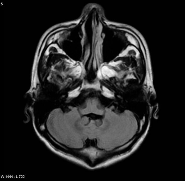 File:Cerebral vasculitis (Radiopaedia 5131-6923 Axial FLAIR 1).jpg
