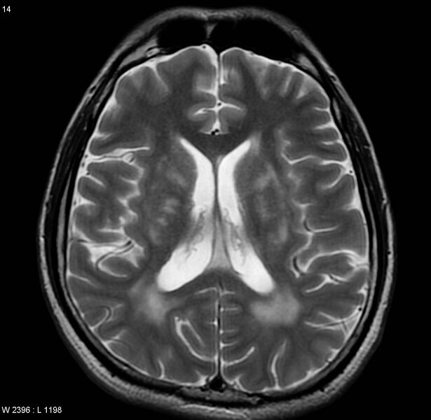 File:Cerebral vasculitis (Radiopaedia 5131-6923 Axial T2 5).jpg