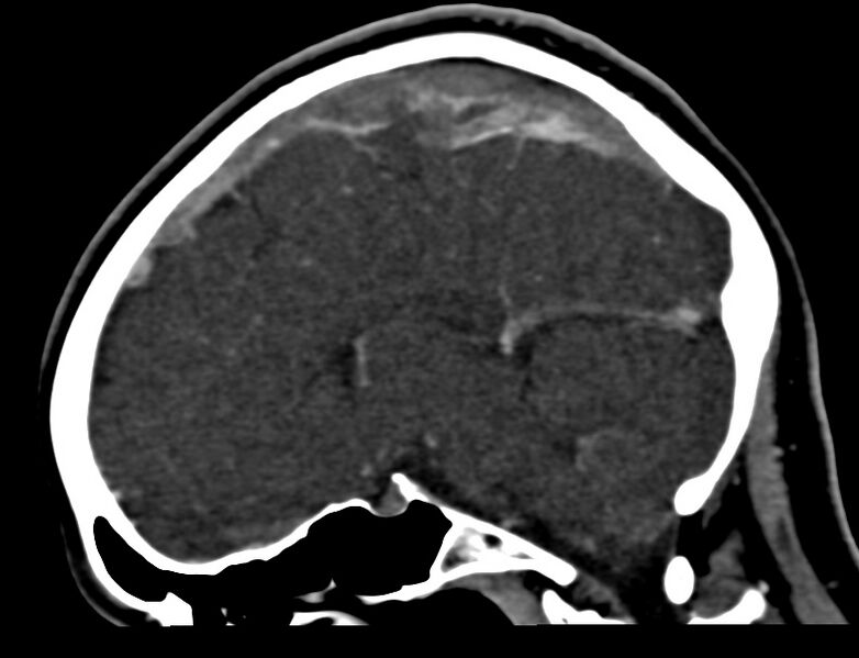 File:Cerebral venous sinus thrombosis (Radiopaedia 59224-66646 Sagittal C+ delayed 21).jpg