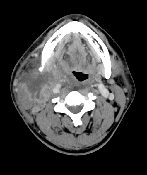 File:Cervical abscess (Radiopaedia 43725-47184 A 29).png