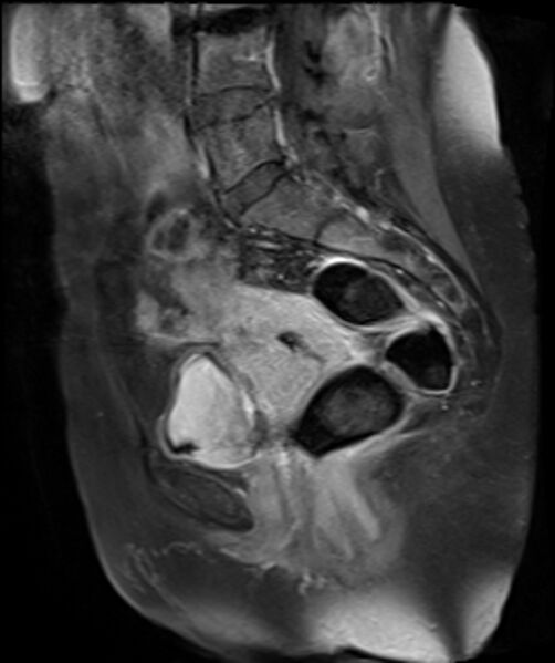 File:Cervical carcinoma (Radiopaedia 88312-104943 E 16).jpg