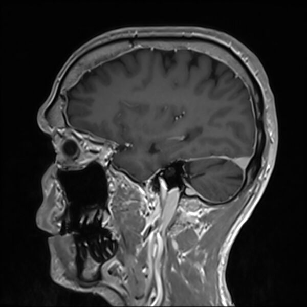 File:Cervical dural CSF leak on MRI and CT treated by blood patch (Radiopaedia 49748-54995 G 26).jpg