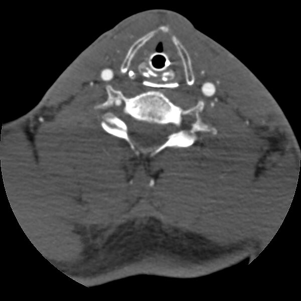 File:Cervical spine fractures with vertebral artery dissection (Radiopaedia 32135-33078 D 34).jpg