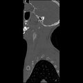 Cervical spine fractures with vertebral artery dissection (Radiopaedia 32135-33078 Sagittal bone window 41).jpg