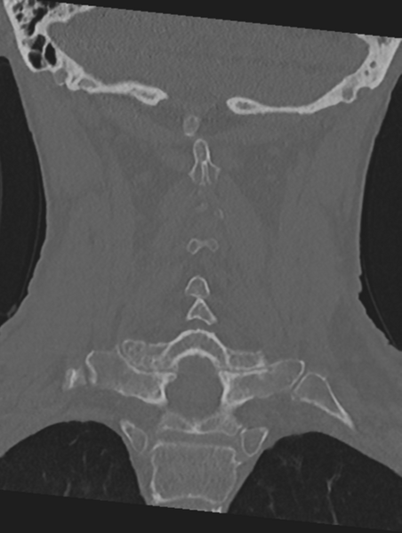 File:Cervical spondylolysis (Radiopaedia 49616-54811 Coronal bone window 35).png