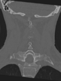 Cervical spondylolysis (Radiopaedia 49616-54811 Coronal bone window 35).png