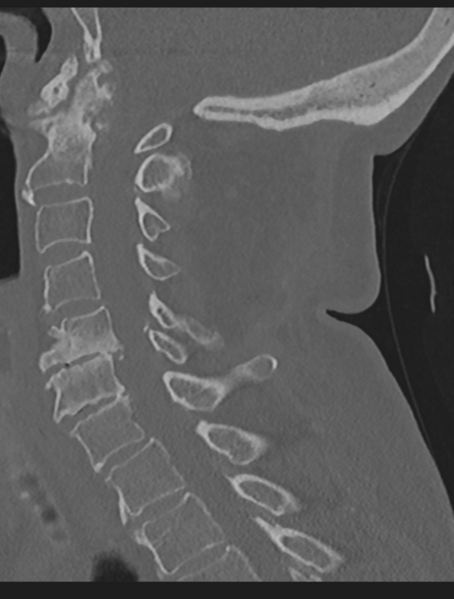 File:Cervical spondylolysis (Radiopaedia 49616-54811 Sagittal bone window 35).png