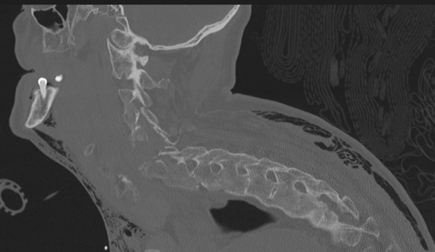 Chalk stick fracture (Radiopaedia 57948-64928 Sagittal bone window 22).png