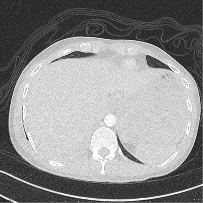 Chest and abdomen multi-trauma (Radiopaedia 26294-26425 lung window 90).jpg
