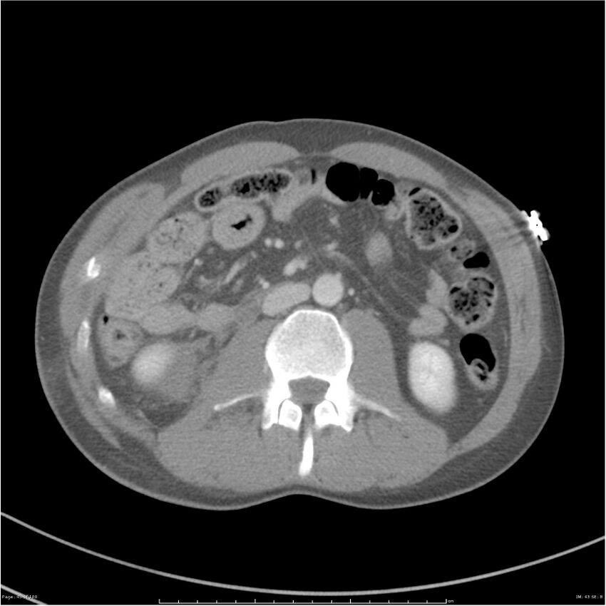 Chest and abdomen multi-trauma (Radiopaedia 26294-26426 A 43).jpg