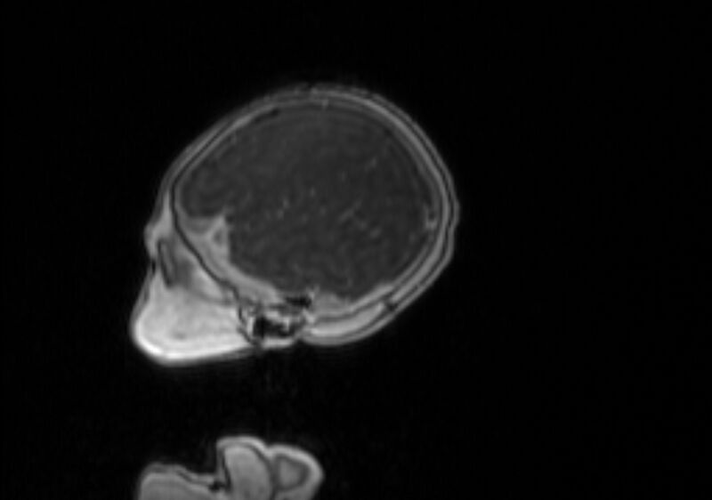 File:Chiari III malformation with occipital encephalocele (Radiopaedia 79446-92559 Sagittal T1 C+ mpr 56).jpg