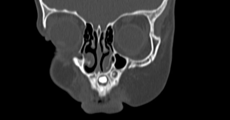 File:Choanal atresia (Radiopaedia 51295-56972 Coronal bone window 4).jpg