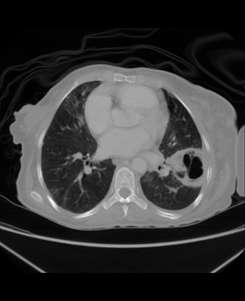 Chondrosarcoma (Radiopaedia 79427-92535 Axial lung window 31).jpg