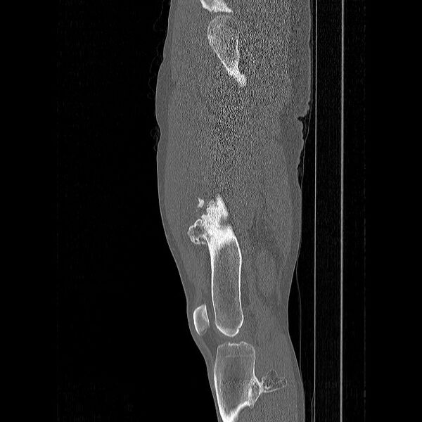 File:Chondrosarcoma arising from exostosis (Radiopaedia 59996-67507 Sagittal bone window 6).jpg