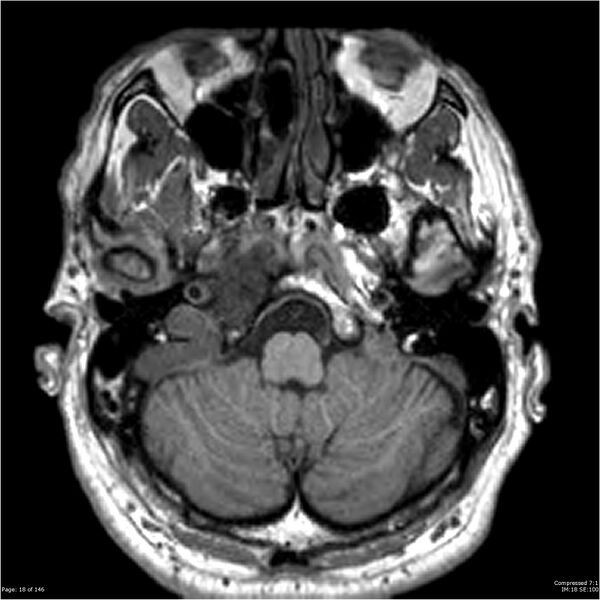 File:Chondrosarcoma of skull base- grade II (Radiopaedia 40948-43654 Axial T1 18).jpg