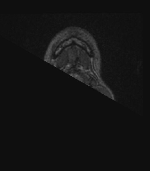 File:Choroid plexus carcinoma (Radiopaedia 91013-108553 Axial FLAIR C+ 14).jpg