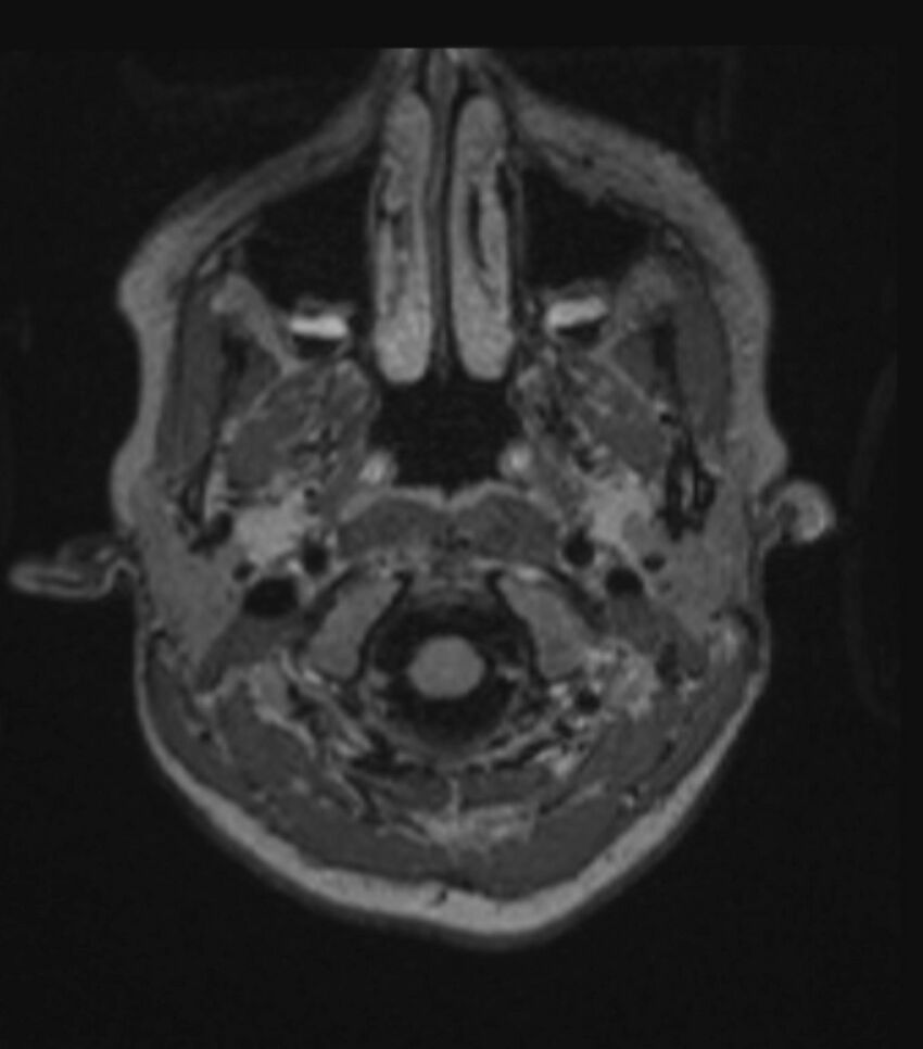 Choroid plexus carcinoma (Radiopaedia 91013-108553 Axial FLAIR C+ 71).jpg