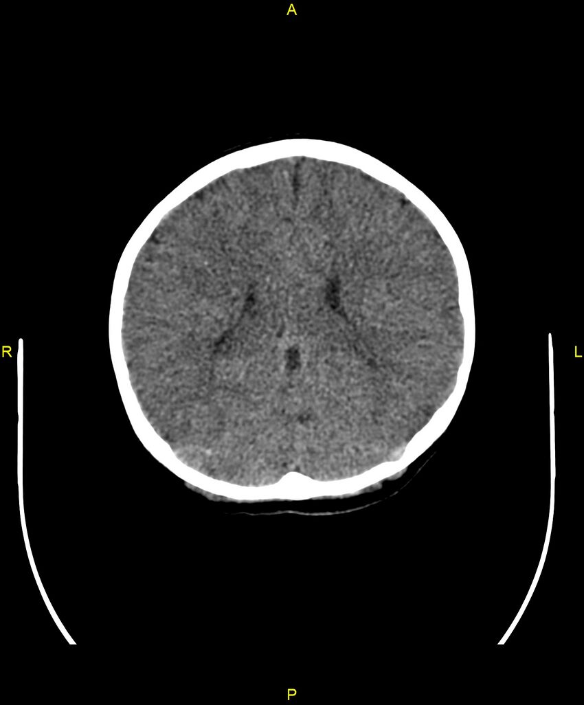 Choroidal fissure cyst (Radiopaedia 89481-106465 Axial non-contrast 76).jpg