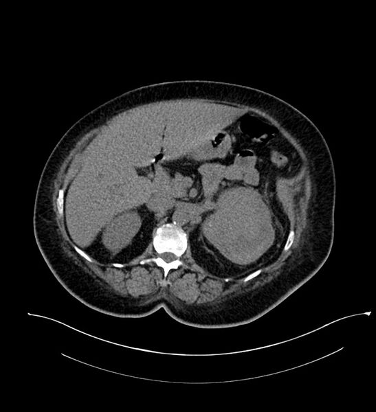 File:Chromophobe renal cell carcinoma (Radiopaedia 84239-99519 Axial non-contrast 64).jpg