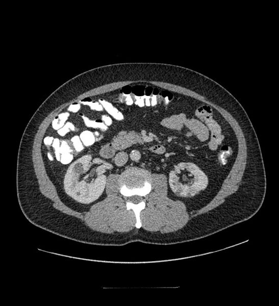 File:Chromophobe renal cell carcinoma (Radiopaedia 84337-99644 C 59).jpg