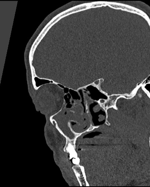 File:Chronic maxillary sinusitis caused by a foreign body (Radiopaedia 58521-65676 Sagittal bone window 3).jpg