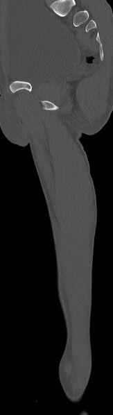 File:Chronic osteomyelitis (with sequestrum) (Radiopaedia 74813-85822 C 49).jpg