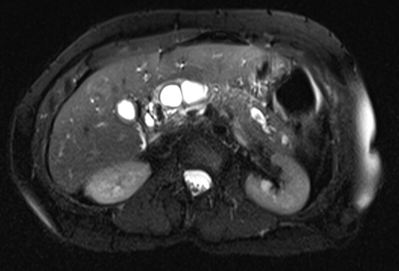 File:Chronic pancreatitis - pancreatic duct calculi (Radiopaedia 71818-82250 Axial T2 fat sat 26).jpg