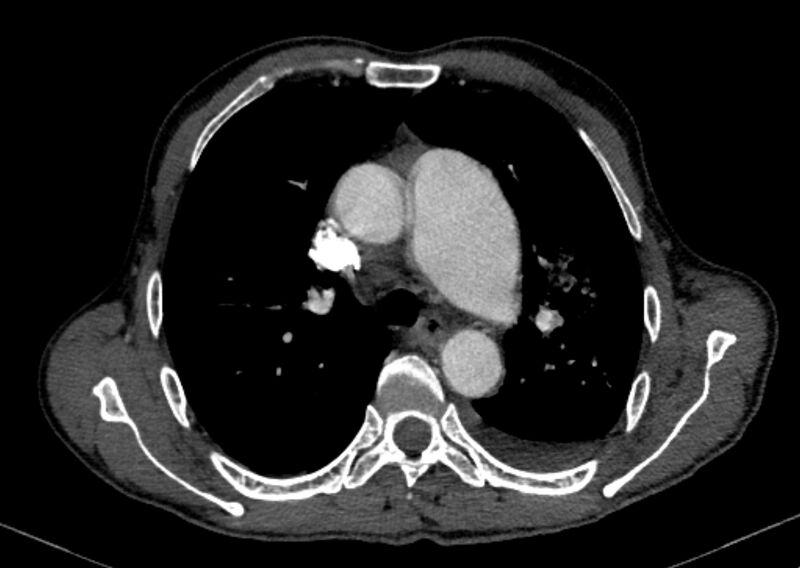 File:Chronic pulmonary embolism with bubbly consolidation (Radiopaedia 91248-108850 C+ arterial phase 51).jpg