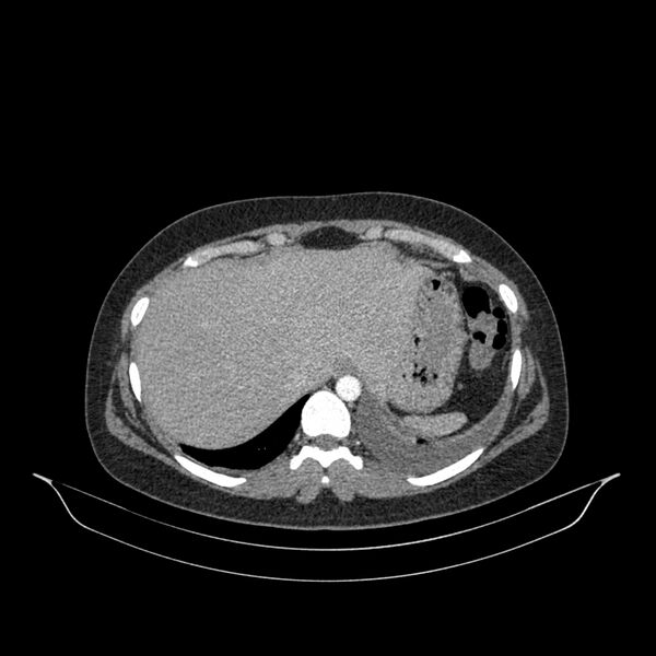 File:Chronic thromboembolic pulmonary hypertension (CTEPH) (Radiopaedia 74597-85532 Axial C+ CTPA 24).jpg