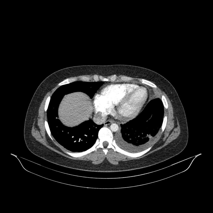 Chronic thromboembolic pulmonary hypertension (CTEPH) (Radiopaedia 74597-85532 Axial C+ CTPA 49).jpg