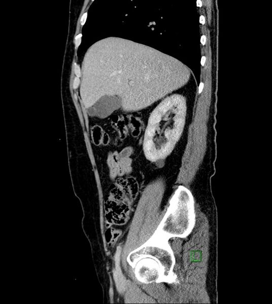 File:Clear cell renal cell carcinoma (Radiopaedia 85006-100539 G 45).jpg