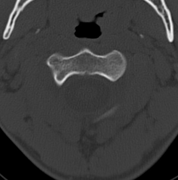 File:Cleft of the posterior arch of C1 mimicking fracture (Radiopaedia 40201-42721 Axial bone window 11).jpg
