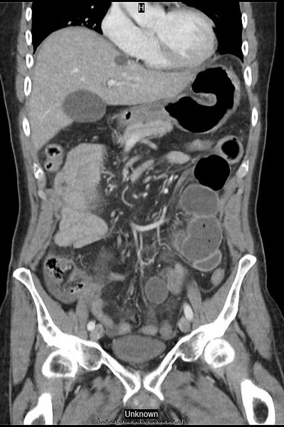 File:Closed loop bowel obstruction and ischemia (Radiopaedia 86959-103180 B 15).jpg