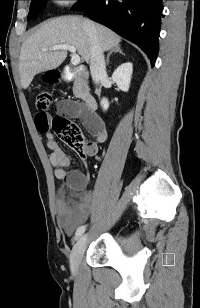File:Closed loop small bowel obstruction - internal hernia (Radiopaedia 57806-64778 C 73).jpg